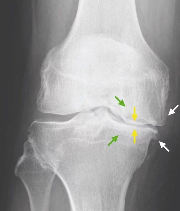 osteoartrita 4 grade ale articulației genunchiului durere sub genunchi la flexie și extindere